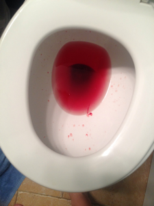 Symptom of anal bleeding